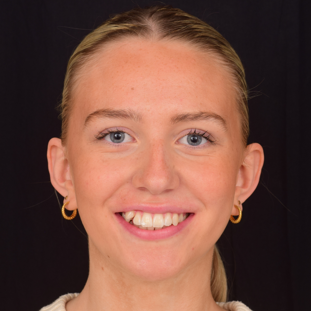 Maia før Invisalign