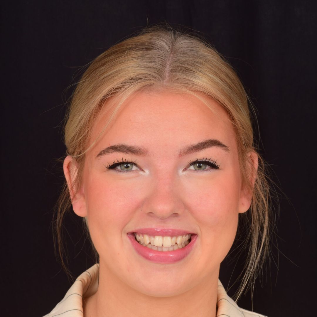 Olivia før behandling med den usynlige bøjle Invisalign