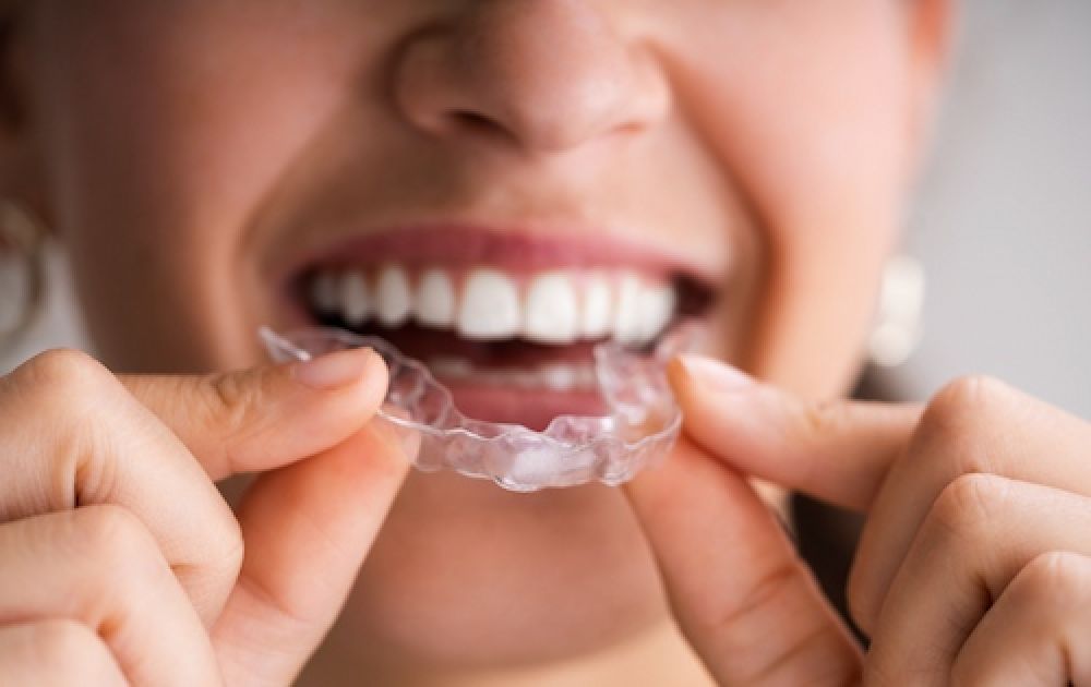 Invisalign er en populær løsning inden for tandregulering for voksne
