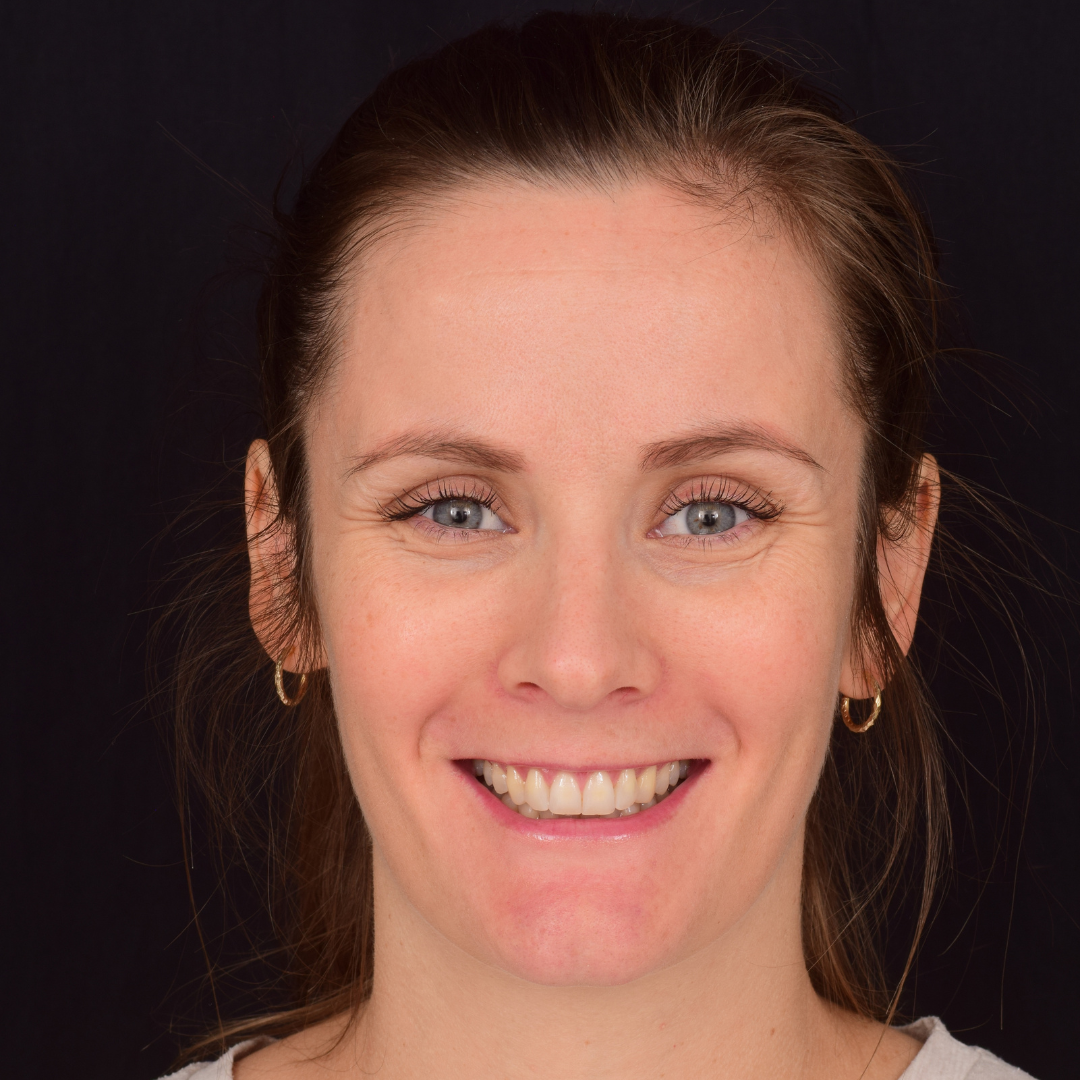 Maia efter Invisalign