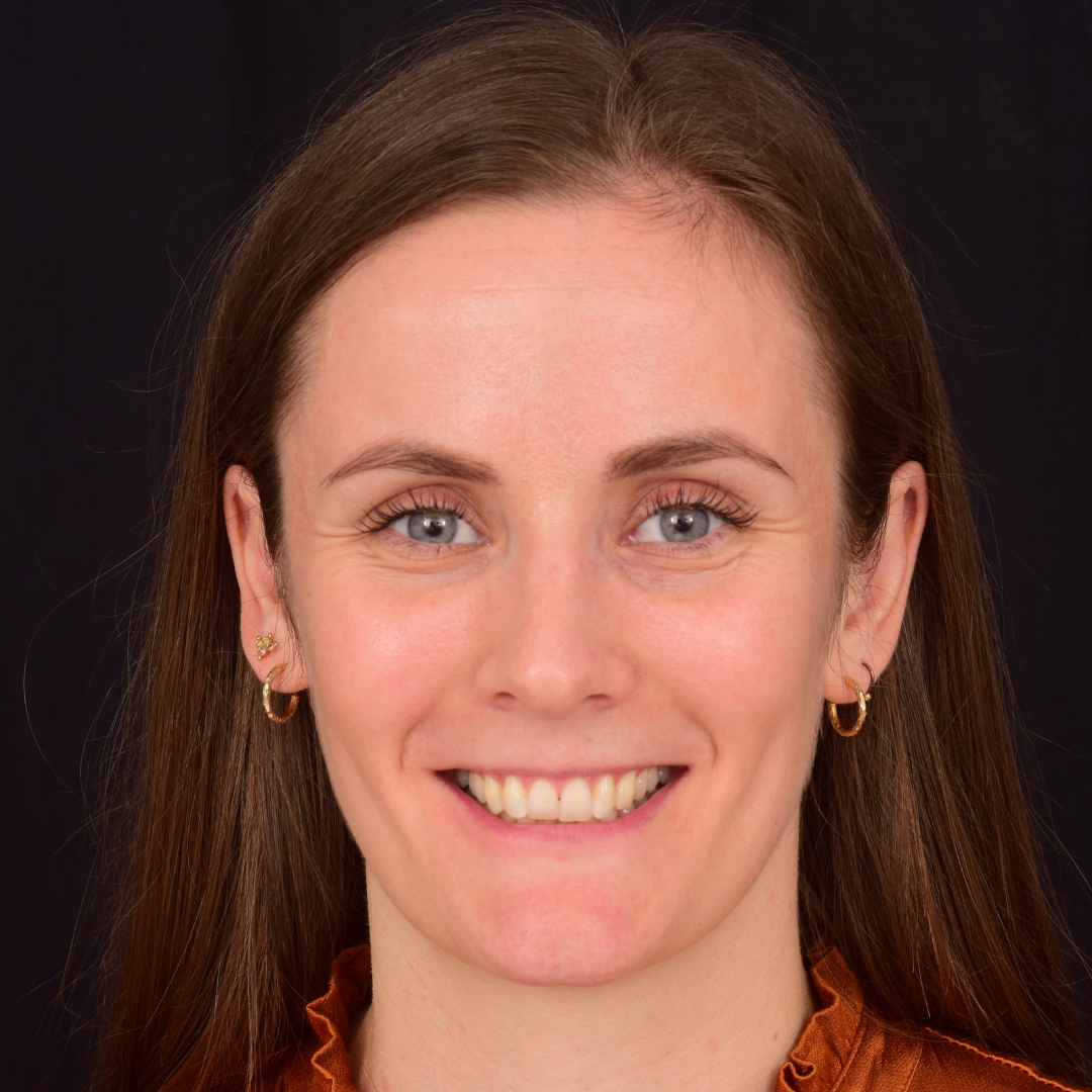 Maria før Invisalign