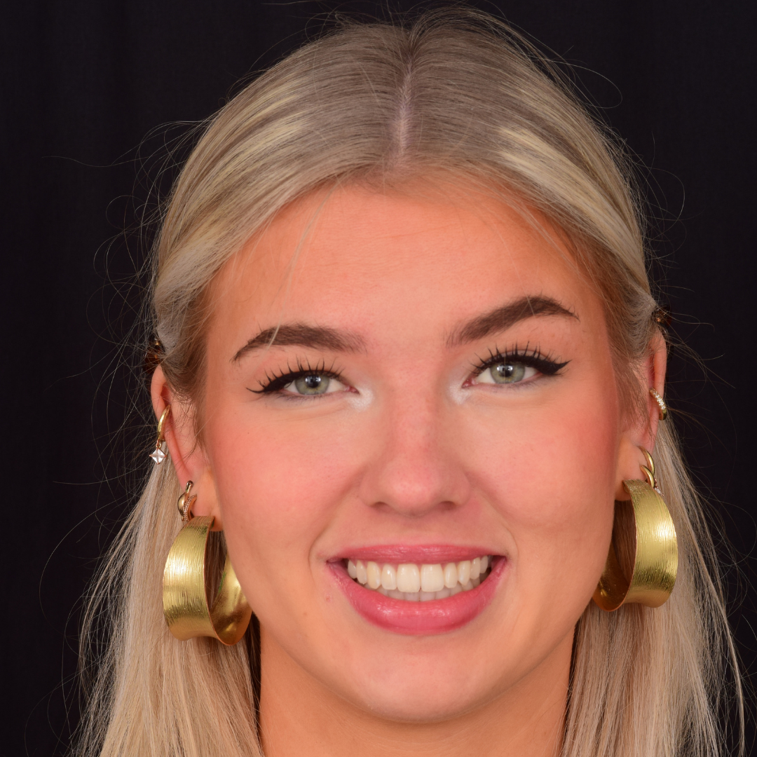 Olivia efter Invisalign