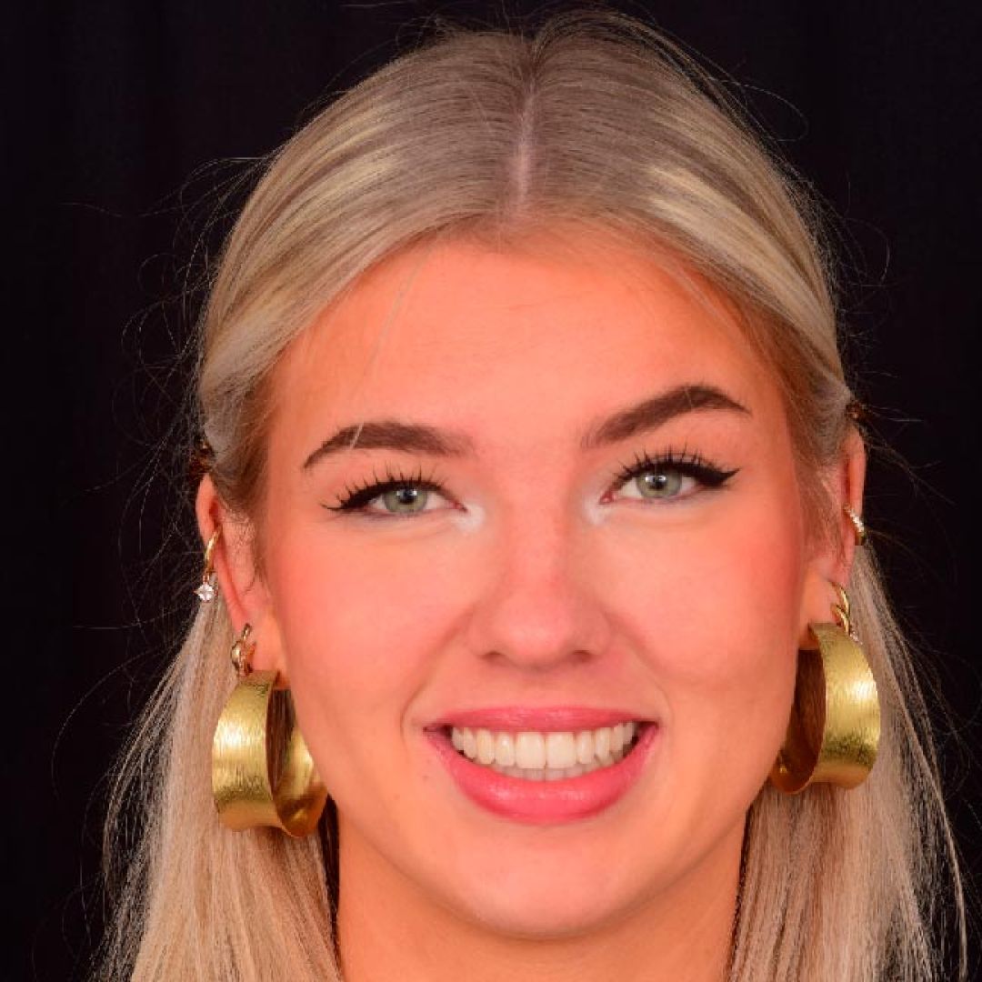 Olivia efter tandretning med Invisalign-skinnerne