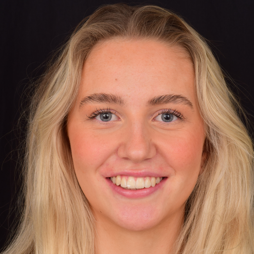 Maia efter Invisalign